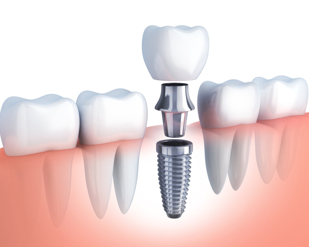 Immagine illustrativa sugli impianti dentali e l'implantologia
