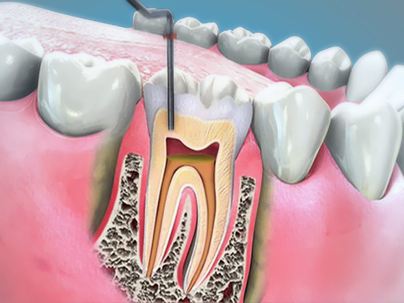 Illustrazione della terapia canalare durante una devitalizzazione dentale