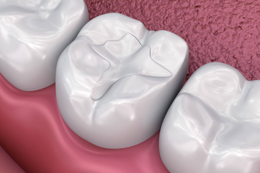 Otturazioni dentali e odontoiatria conservativa a Rho: immagine illustrativa del trattamento