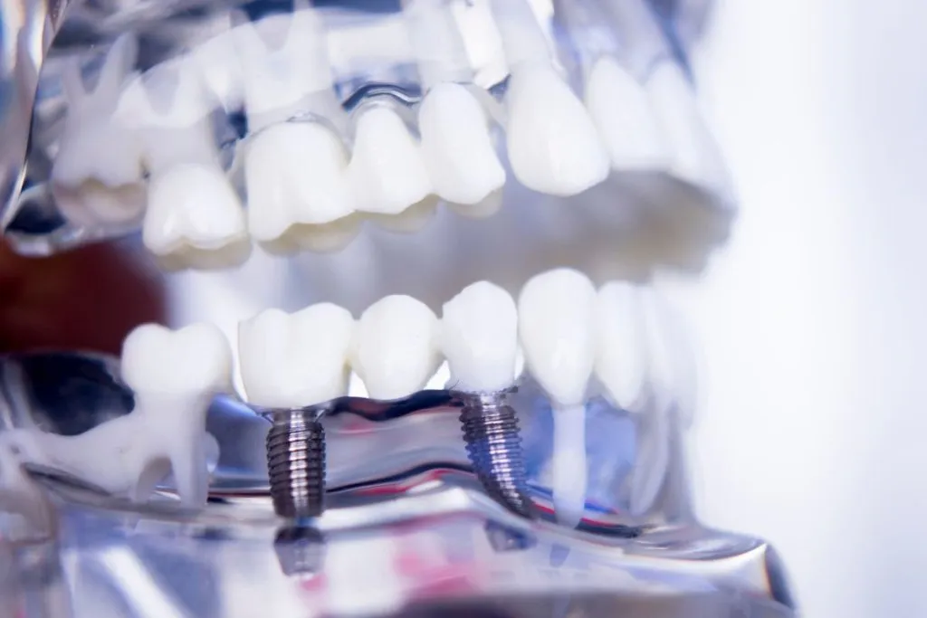 Restauri protesici fissi e denti sostituiti con corone o ponti