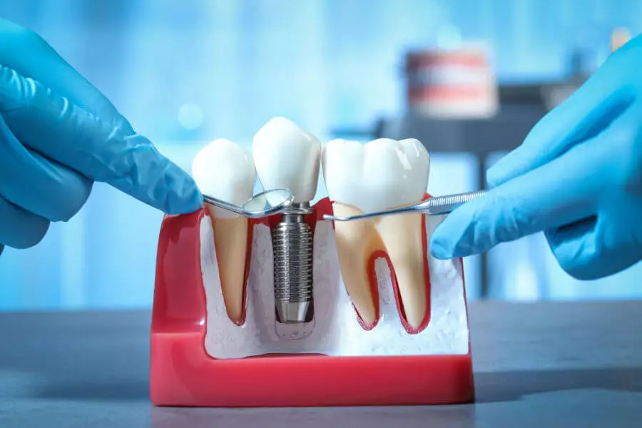 Immagine illustrativa relativa a procedure di implantologia dentale