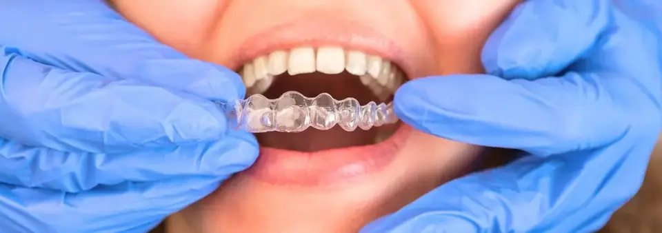 Mascherina trasparente per ortodonzia - OrthoSmile, studio dentistico a Rho