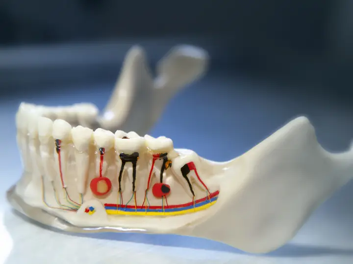 Modello odontoiatrico per la terapia canalare