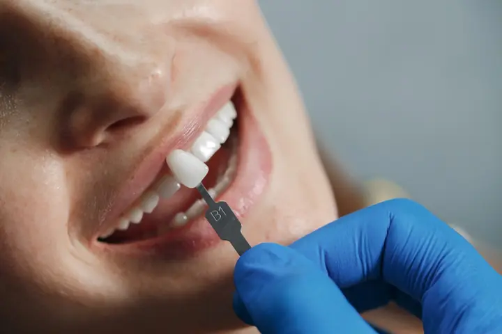 Campione per la valutazione del colore dentale - faccette e studio dentistico OrthoSmile a Rho