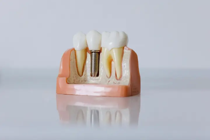 Modello didattico di impianto dentale